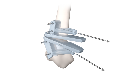 distal osteotomy